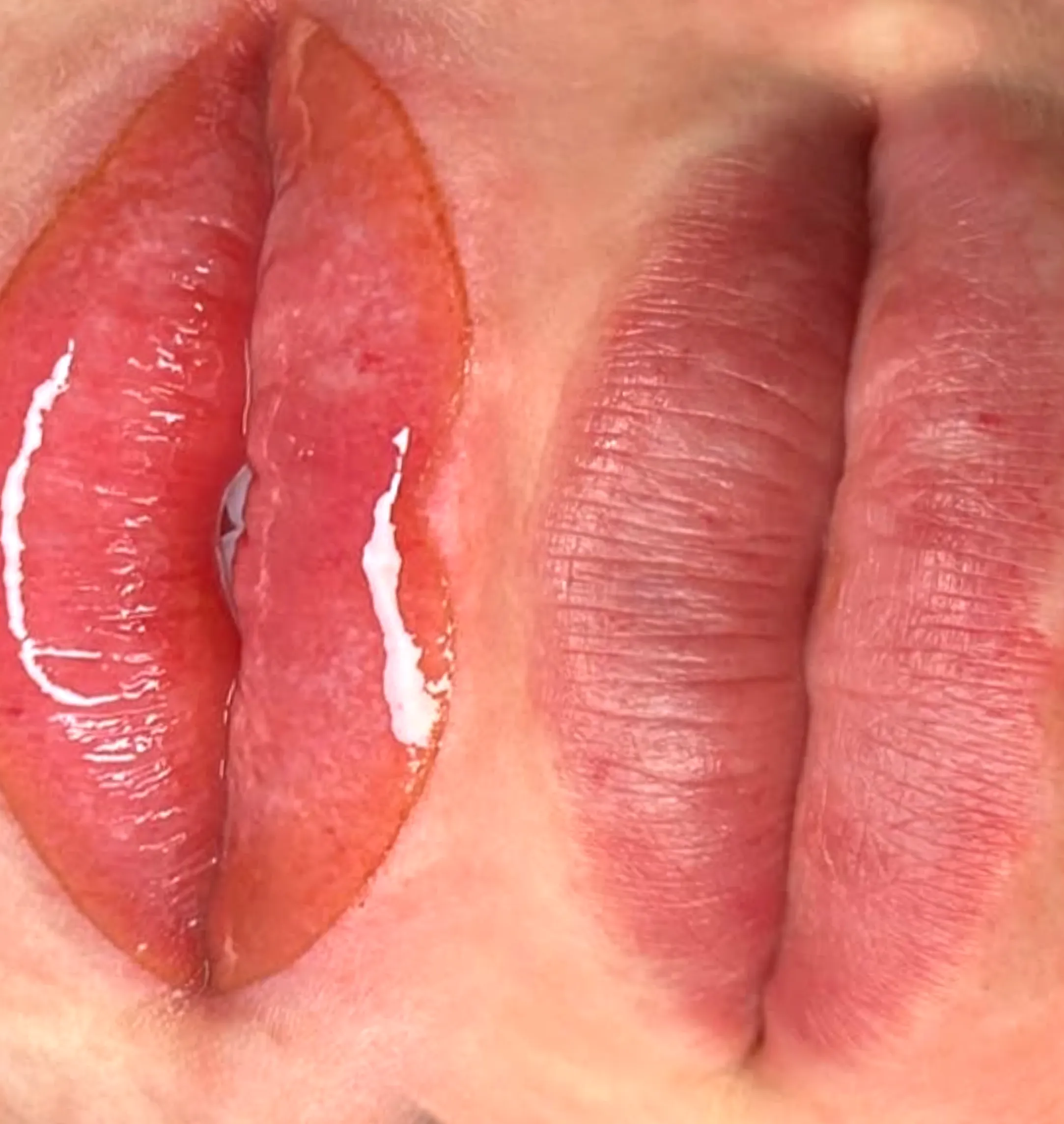 cold sores after lip tattoo